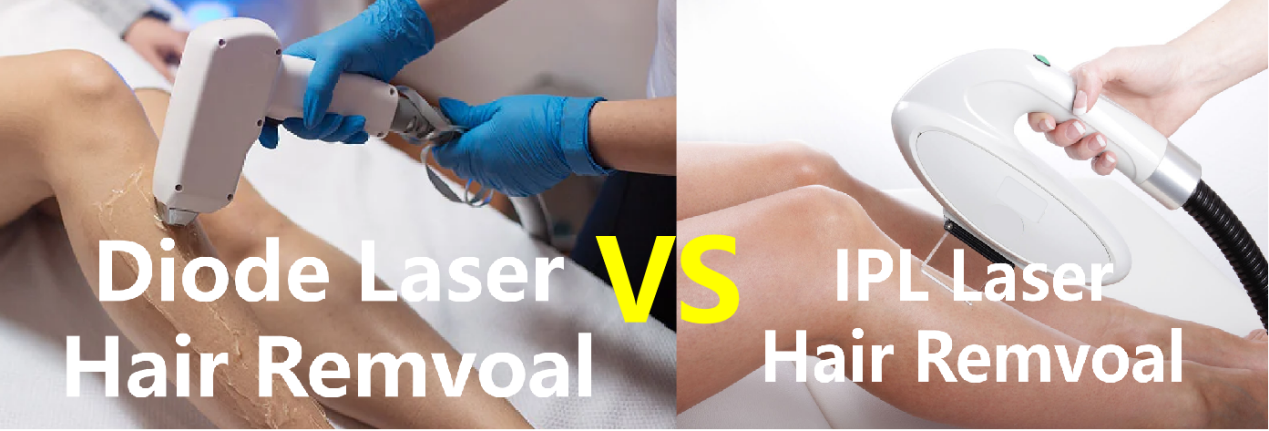 IPL VS DIODE LASER HÅRFJERNING