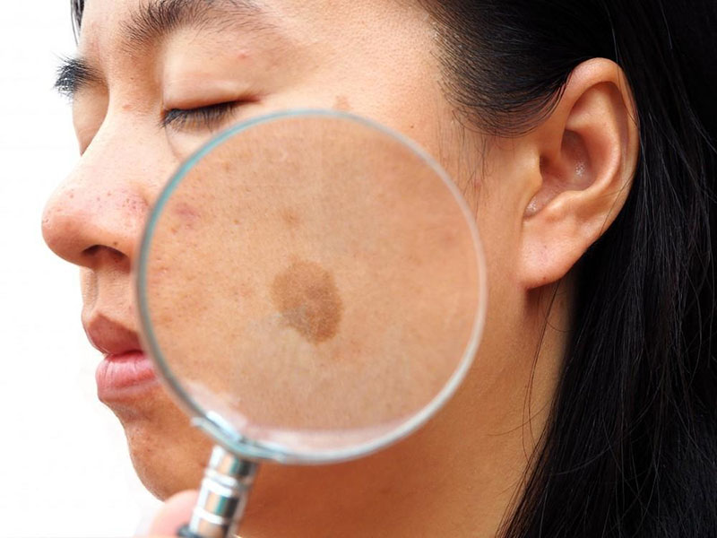 Picosecond Laser: En god hjælper til at fjerne Melasma
