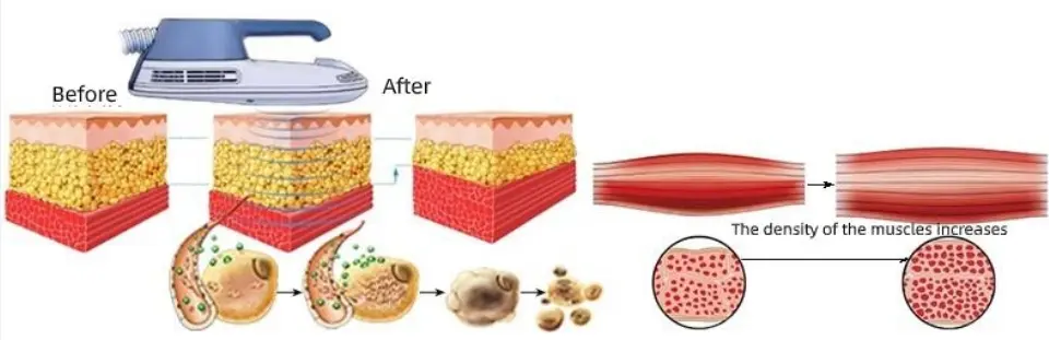 Vertical Rf Ems Body Weight Loss Machine